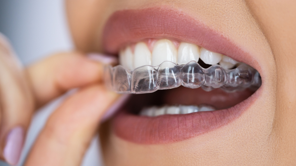 Aligner – Die bequeme Alternative zur Zahnspange