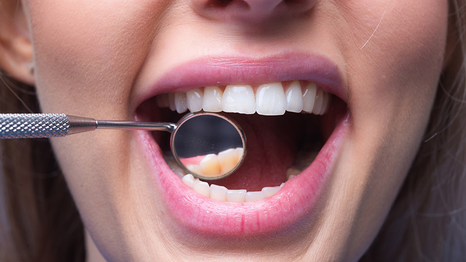 Zahngesundheit: Frau, die ihren Mund für eine Zahnbehandlung öffnet - strahlend weiße Zähne