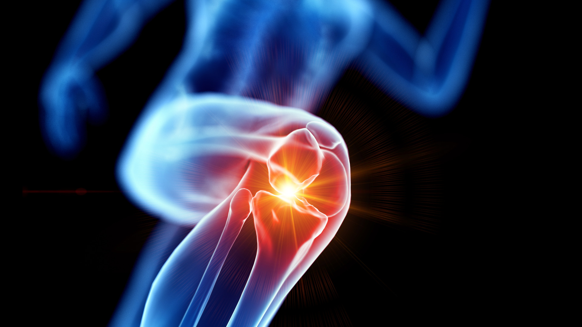 Symbolbild: Grafik des menschlichen Körpers mit der Schmerzstelle des Knies