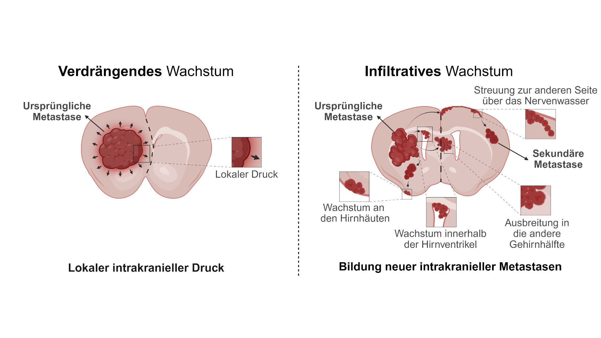 neue studie zu metastasen ueberrascht was sie fuer krebs therapien bedeuten koennte 2